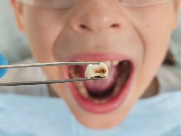 Best Dentist for Tooth Abscess  in Twain Harte, CA